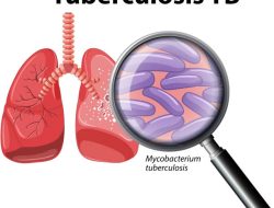Peran Aktif Desa Kunci Eliminasi TBC di Sumbawa
